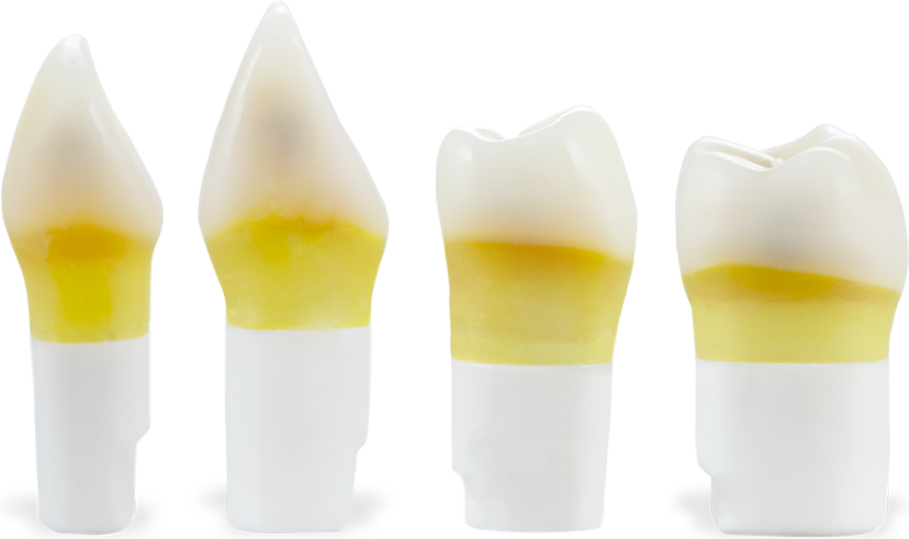 DTX Carious Teeth